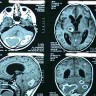 Clinical Neurophysiology